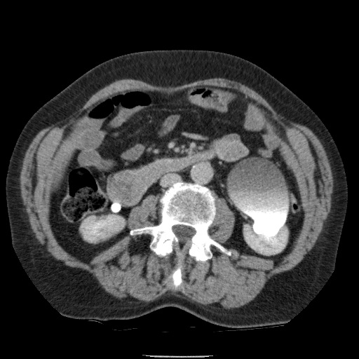 Bladder tumor detected on trauma CT (Radiopaedia 51809-57609 C 67).jpg