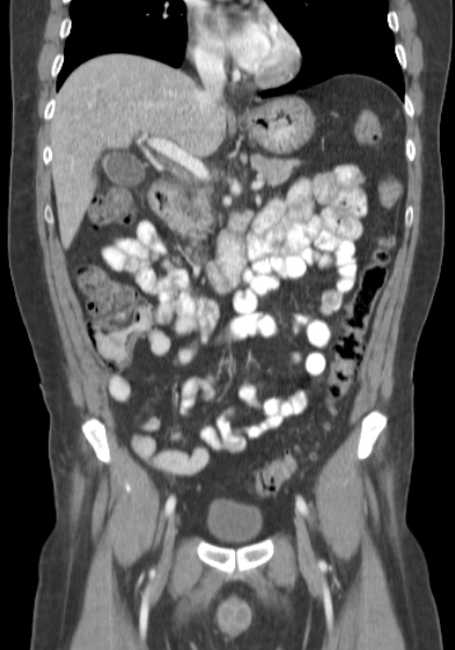 Bleeding duodenal ulcer and adenomyomatosis of gallbladder (Radiopaedia 61834-69861 B 49).jpg