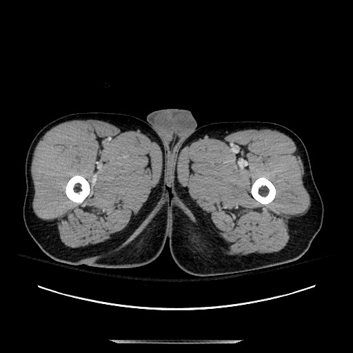 Blunt abdominal trauma with solid organ and musculoskelatal injury with active extravasation (Radiopaedia 68364-77895 A 190).jpg