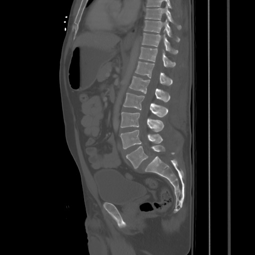 Blunt abdominal trauma with solid organ and musculoskelatal injury with active extravasation (Radiopaedia 68364-77895 Sagittal bone window 54).jpg