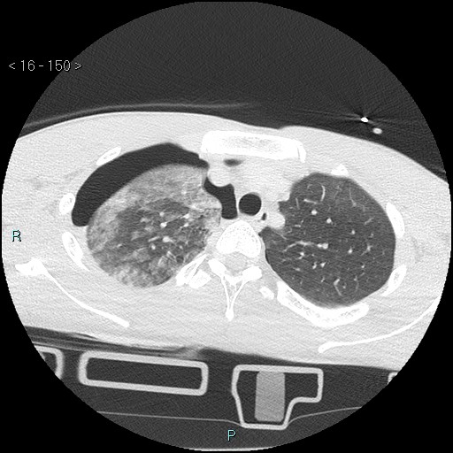 Blunt chest trauma (Swiss cheese sign) (Radiopaedia 38519-40618 Axial lung window 15).jpg