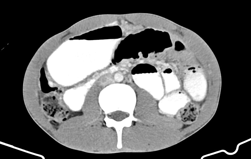 Blunt injury to the small bowel (Radiopaedia 74953-85987 A 84).jpg