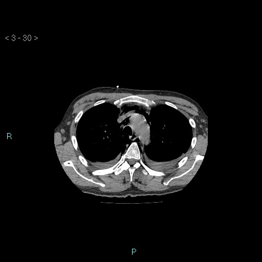 Boerhaave syndrome (Radiopaedia 27683-27897 Axial non-contrast 30).jpg