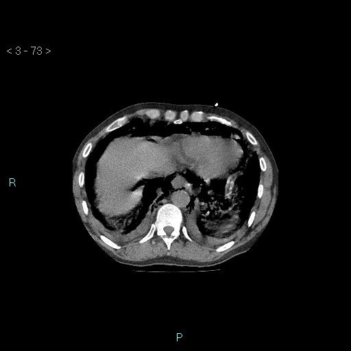 Boerhaave syndrome (Radiopaedia 27683-27897 Axial non-contrast 73).jpg