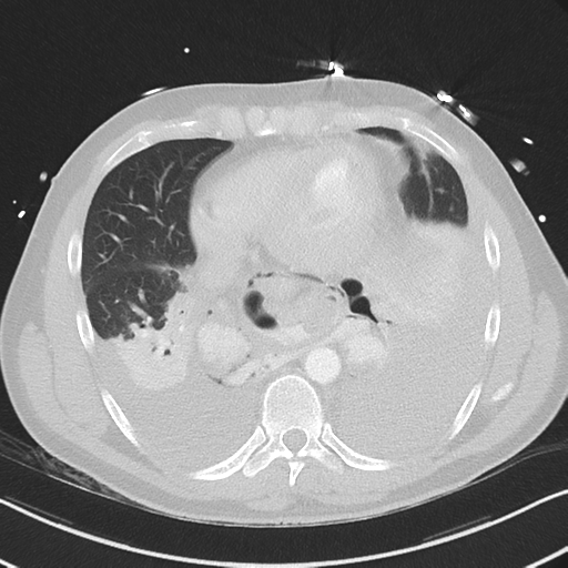 Boerhaave syndrome (Radiopaedia 39382-41661 Axial lung window 39).png