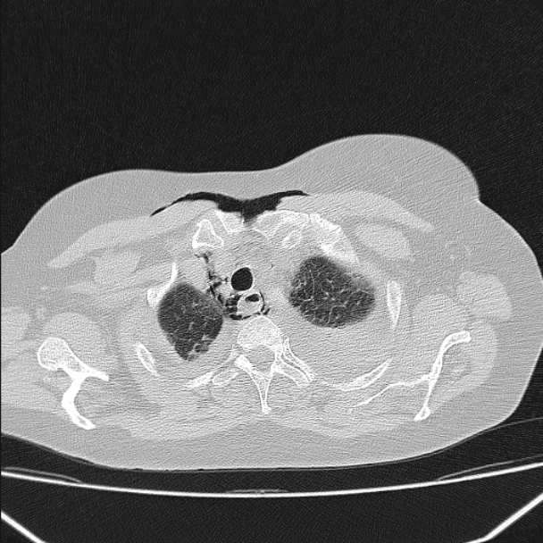 Boerhaave syndrome (Radiopaedia 45644-49799 Axial lung window 36).jpg