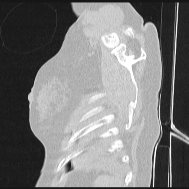 Boerhaave syndrome (Radiopaedia 45644-49799 Sagittal lung window 82).jpg