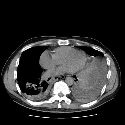 Boerhaave syndrome (Radiopaedia 59796-67310 Axial liver window 42).jpg
