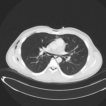 File:Boerhaave syndrome with mediastinal, axillary, neck and epidural free gas (Radiopaedia 41297-44115 Axial lung window 51).jpg