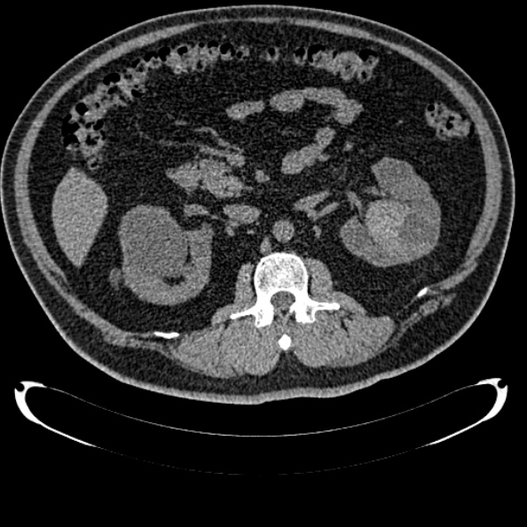 Bosniak renal cyst - type IV (Radiopaedia 24244-24518 Axial non-contrast 143).jpg