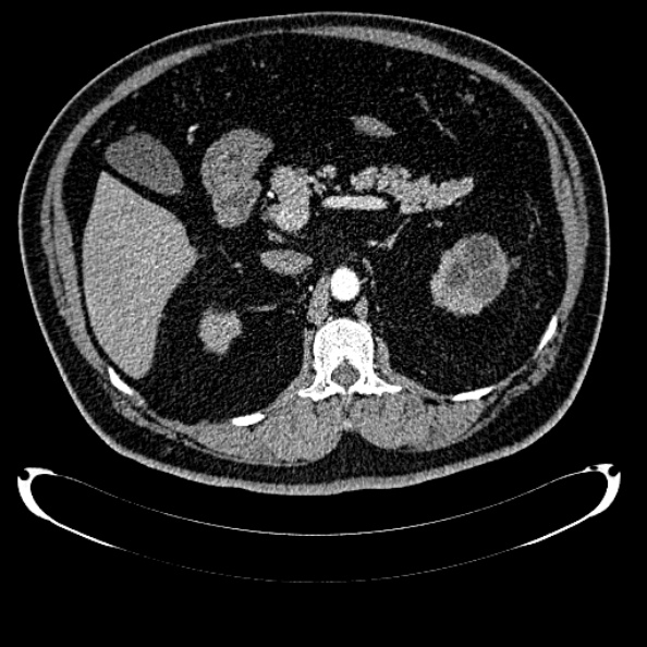Bosniak renal cyst - type IV (Radiopaedia 24244-24518 B 110).jpg