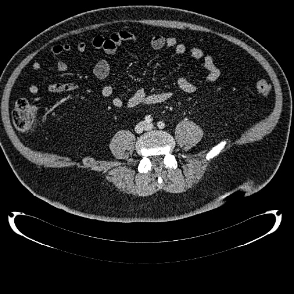 File:Bosniak renal cyst - type IV (Radiopaedia 24244-24518 C 248).jpg