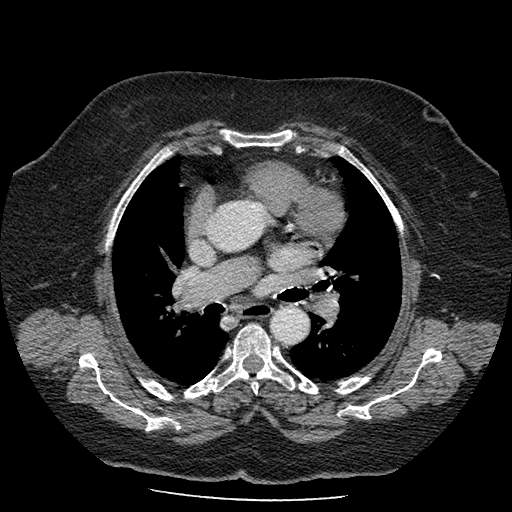 Bovine aortic arch - right internal mammary vein drains into the superior vena cava (Radiopaedia 63296-71875 A 69).jpg
