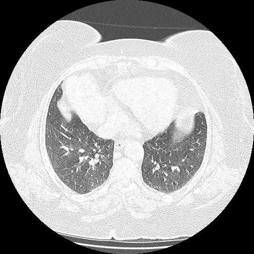 Bovine aortic arch - right internal mammary vein drains into the superior vena cava (Radiopaedia 63296-71875 Axial lung window 113).jpg