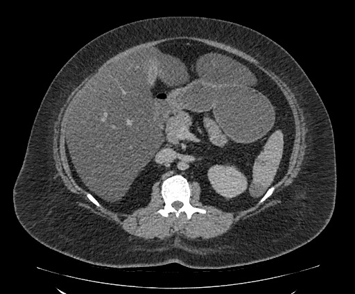 Bowel and splenic infarcts in acute lymphocytic leukemia (Radiopaedia 61055-68913 A 53).jpg