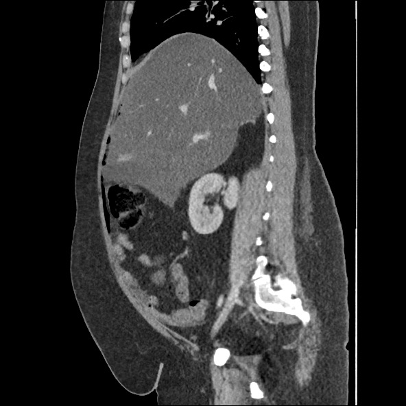 Bowel and splenic infarcts in acute lymphocytic leukemia (Radiopaedia 61055-68915 C 43).jpg