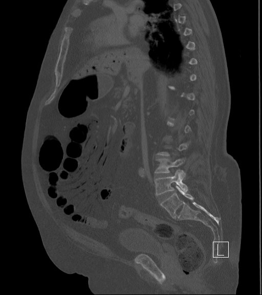 File:Bowel ischemia secondary to SMA occlusion with extensive portomesenteric venous gas (Radiopaedia 54656-60871 Sagittal bone window 59).jpg