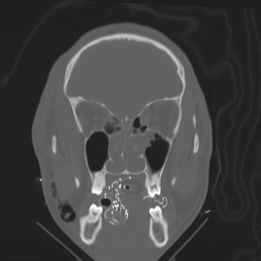 Brain contusions, internal carotid artery dissection and base of skull fracture (Radiopaedia 34089-35339 Coronal bone window 22).png