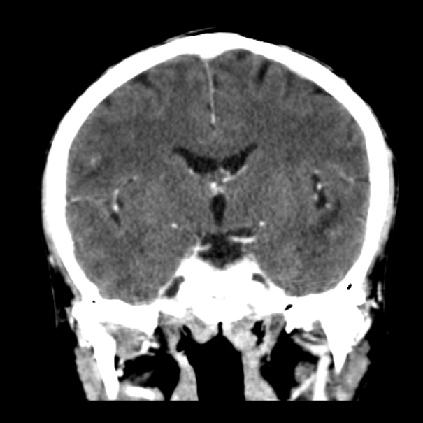 Brain metastases from lung cancer (Radiopaedia 24480-24781 Coronal C+ delayed 31).jpg