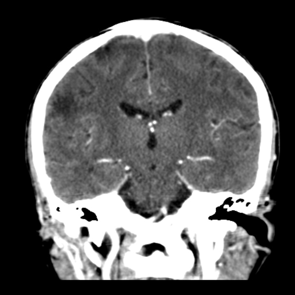 Brain metastases from lung cancer (Radiopaedia 24480-24781 Coronal C+ delayed 35).jpg
