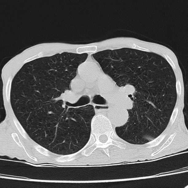 Brain metastases from lung cancer (Radiopaedia 27849-28093 Axial lung window 27).jpg