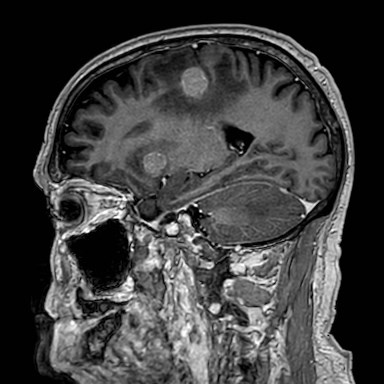 Brain metastases from lung cancer (Radiopaedia 83839-99028 Sagittal T1 C+ 42).jpg