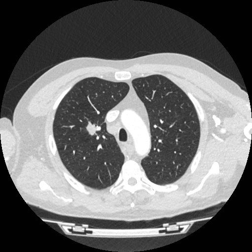 File:Brain metastases from lung cancer (Radiopaedia 83839-99030 Axial lung window 13).jpg