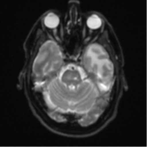 Brain metastasis (large cystic mass) (Radiopaedia 47497-52107 Axial DWI 8).png