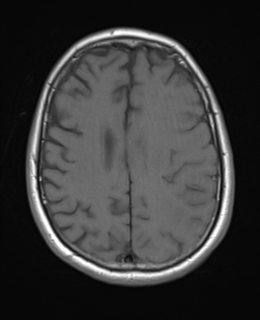 File:Brain metastasis (large cystic mass) (Radiopaedia 47497-52107 Axial T1 19).png