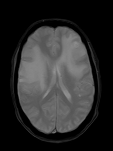 File:Brain metastasis as initial presentation of non-small cell lung cancer (Radiopaedia 65122-74126 Axial T2* 12).jpg