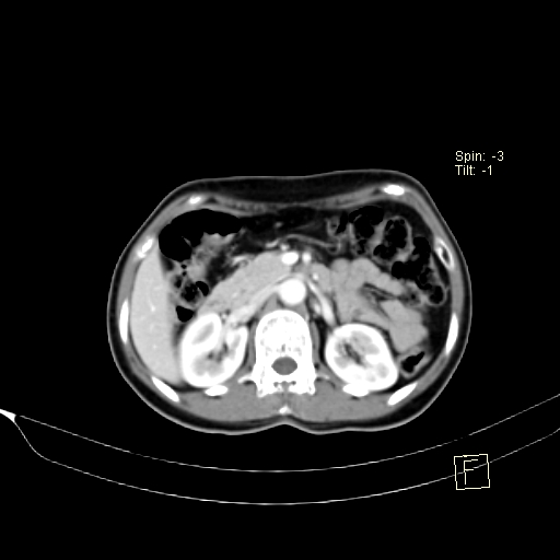 Brain metastasis as initial presentation of non-small cell lung cancer (Radiopaedia 65122-74127 A 58).jpg