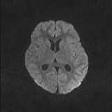 Brainstem glioma (Radiopaedia 67531-76922 Axial DWI 60).jpg