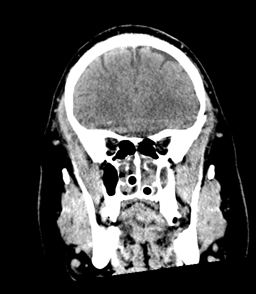 Brainstem hemorrhage (Radiopaedia 81294-94976 Coronal non-contrast 19).jpg