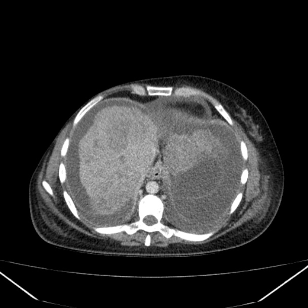 Breast cancer metastases - hepatic and skeletal (Radiopaedia 34201-35461 A 38).jpg