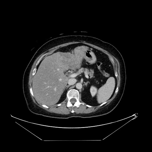 File:Breast cancer pseudocirrhosis with lobar invovlement (Radiopaedia 81080-94670 A 54).jpg
