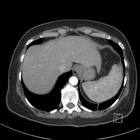 Breast metastases from renal cell cancer (Radiopaedia 79220-92225 A 78).jpg