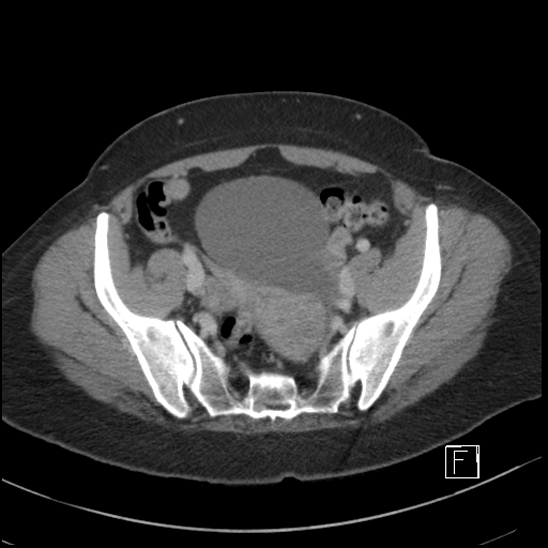 File:Breast metastases from renal cell cancer (Radiopaedia 79220-92225 C 92).jpg
