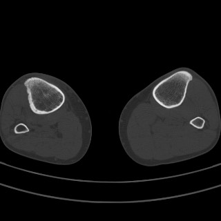 Brodie abscess - tibia (Radiopaedia 66028-75204 Axial bone window 17).jpg