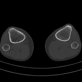 Brodie abscess - tibia (Radiopaedia 66028-75204 Axial bone window 6).jpg