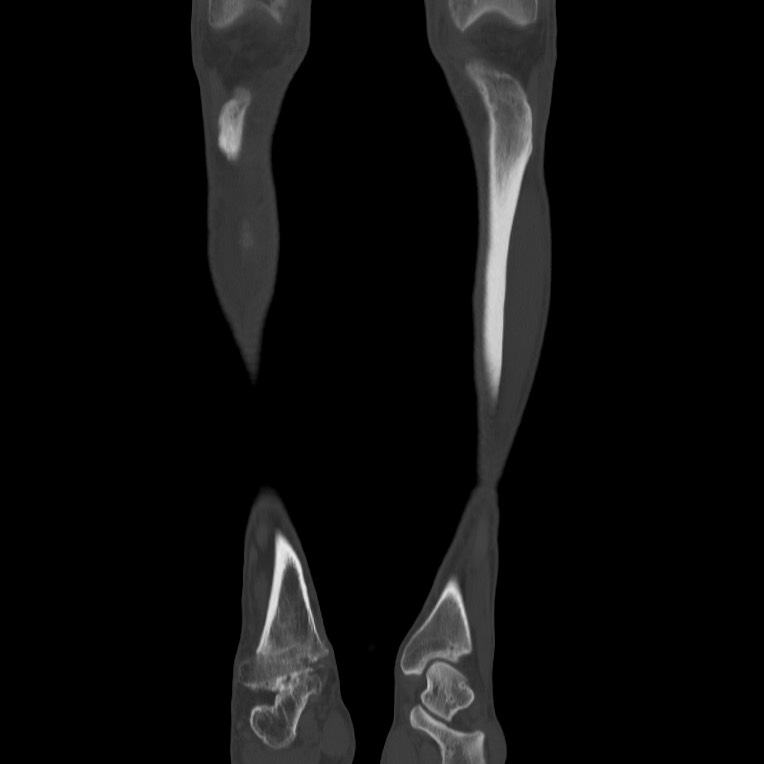 Brodie abscess - tibia (Radiopaedia 66028-75204 Coronal bone window 1).jpg
