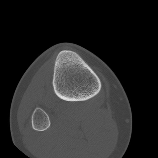 Brodie abscess of the tibia (Radiopaedia 58984-66250 Axial bone window 85).jpg