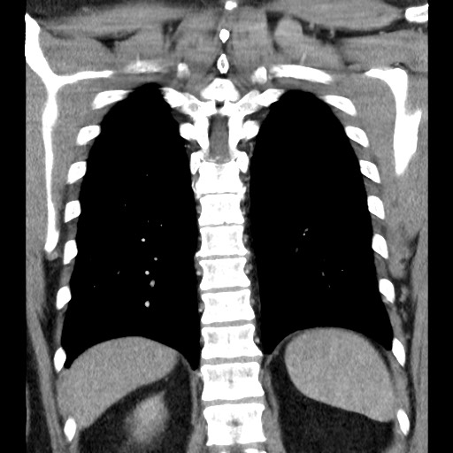 Bronchial carcinoid tumor (Radiopaedia 67377-76764 C 50).jpg
