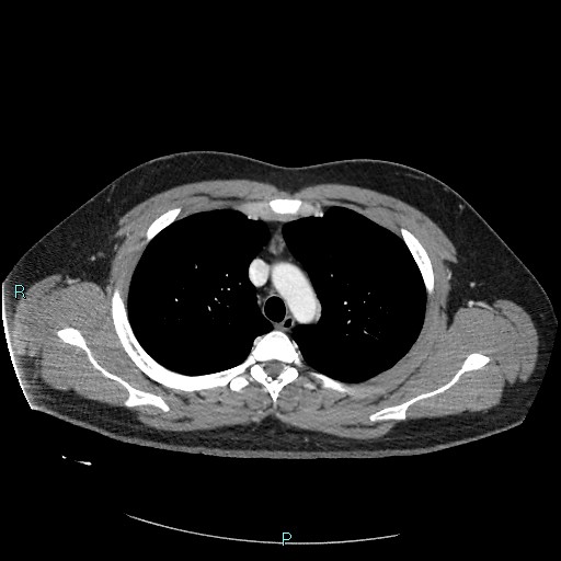 File:Bronchial carcinoid tumor (Radiopaedia 78272-90875 A 32).jpg
