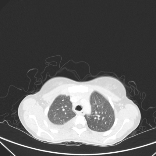 Bronchial mucoepidermoid carcinoma (Radiopaedia 57023-63895 Axial lung window 26).jpg