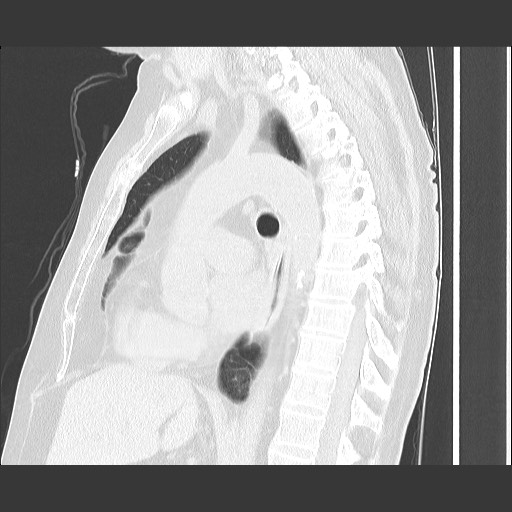 Bronchial stenosis - lung transplant (Radiopaedia 73133-83848 Sagittal lung window 37).jpg
