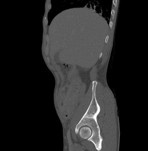 Bronchiectasis in Crohn disease (Radiopaedia 60311-67977 Sagittal bone window 32).jpg