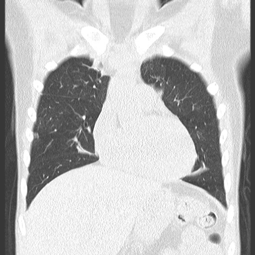 File:Bronchiolotis obliterans (Radiopaedia 73769-84575 Coronal lung window 14).jpg