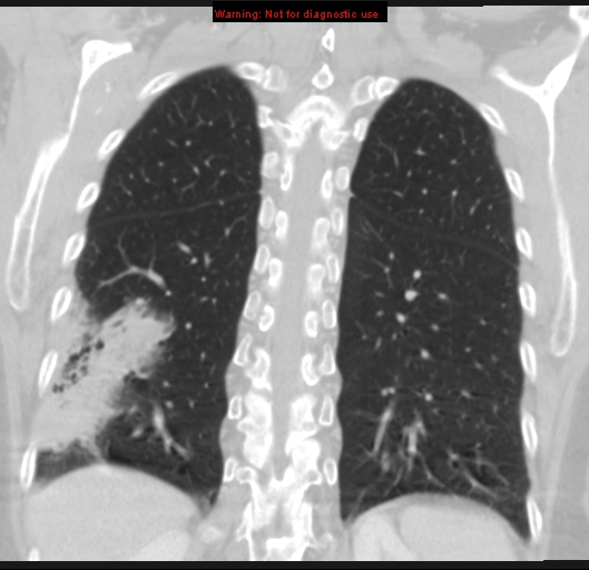 Bronchoalveolar carcinoma (BAC) (Radiopaedia 13436-13392 Coronal lung window 45).jpg