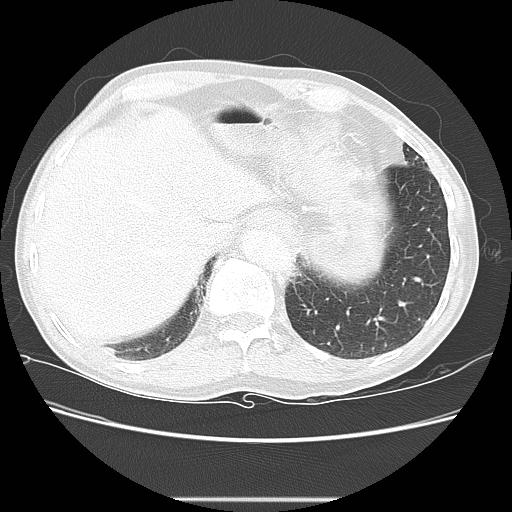 Bronchocele (Radiopaedia 17097-16795 Axial lung window 101).jpg