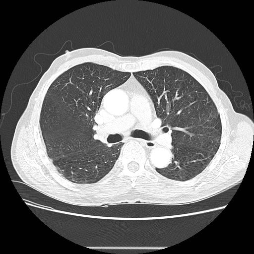 Bronchocele (Radiopaedia 17097-16795 Axial lung window 53).jpg